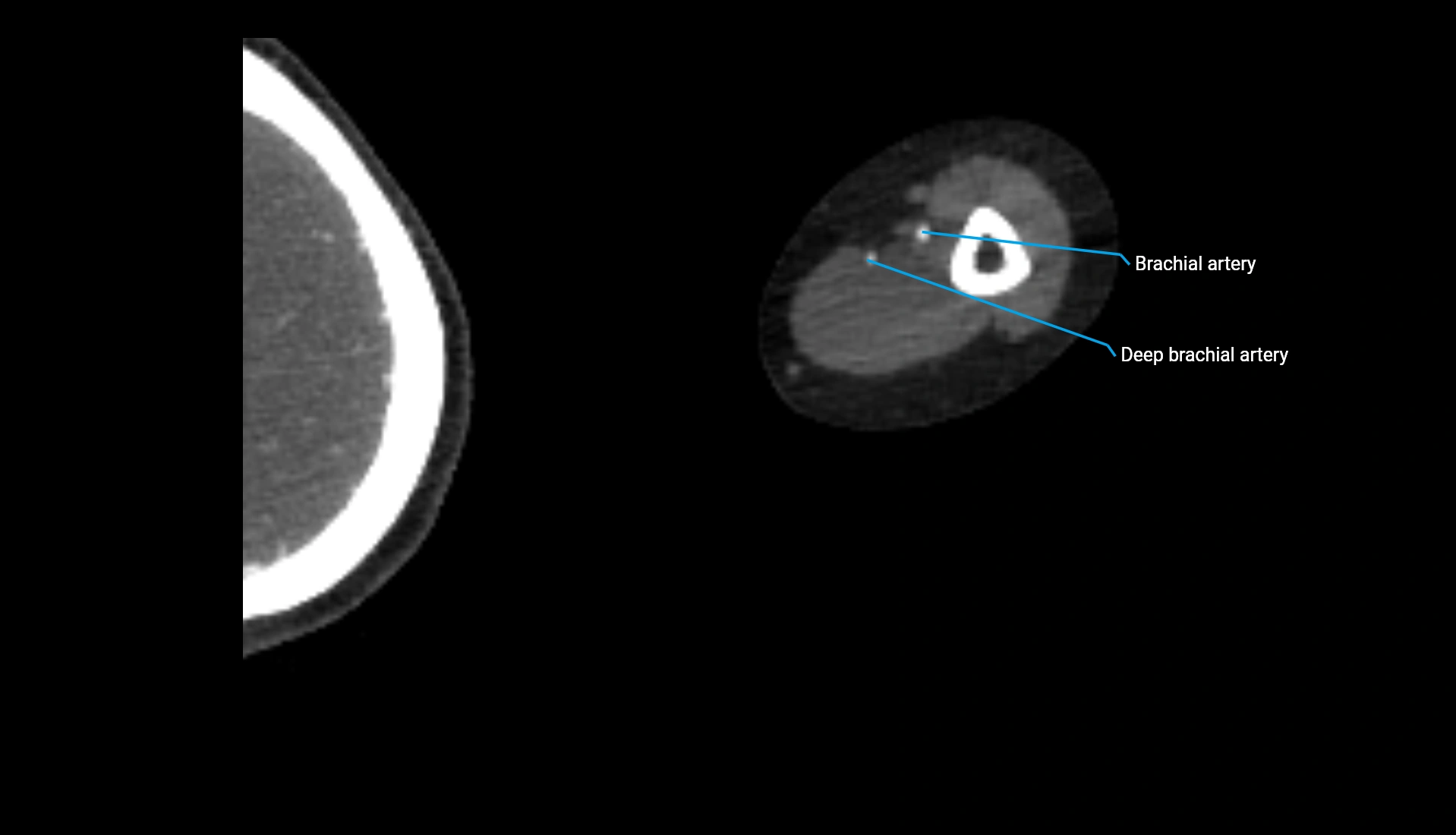 CTA upper limb axial cross sectional anatomy labelled image 222 (2).webp